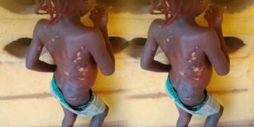Mother arrested in Anambra for using hot knife on 7-year-old daughter
